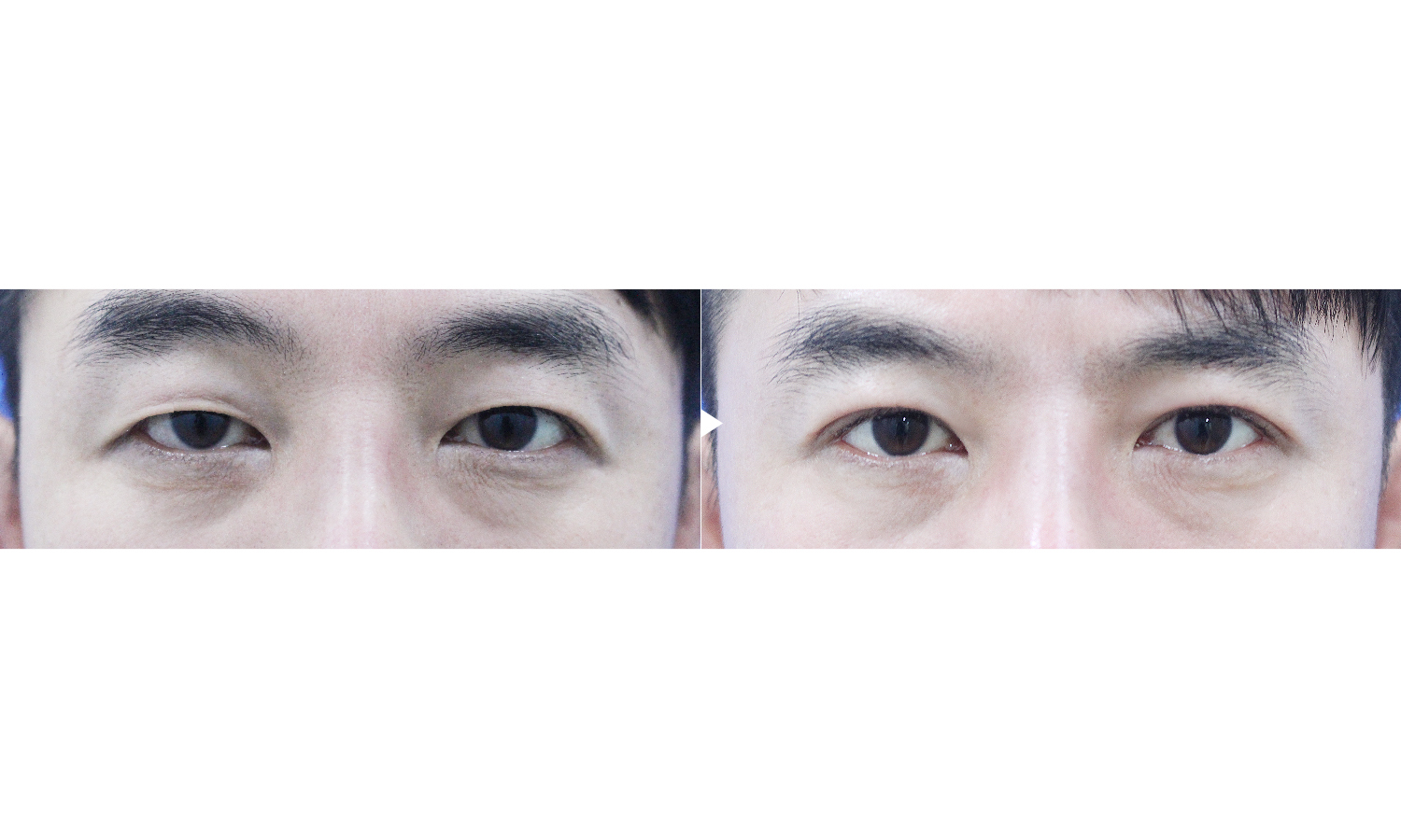 对比案例眼部男性眼整形2