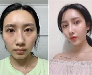 自体脂肪填充会后悔吗？韩国人因为这样才选择可来熙！